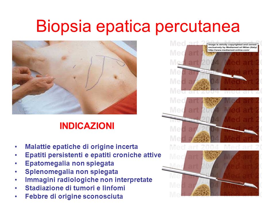 Biopsia epatica percutanea