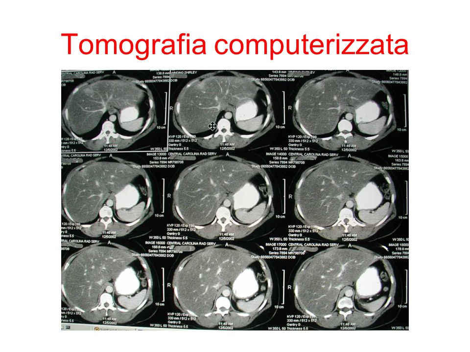 Tomografia computerizzata