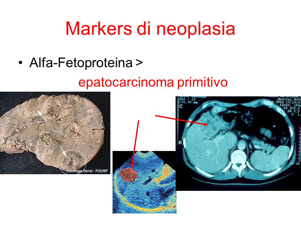 Markers di neoplasia Alfa-Fetoproteina > epatocarcinoma primitivo