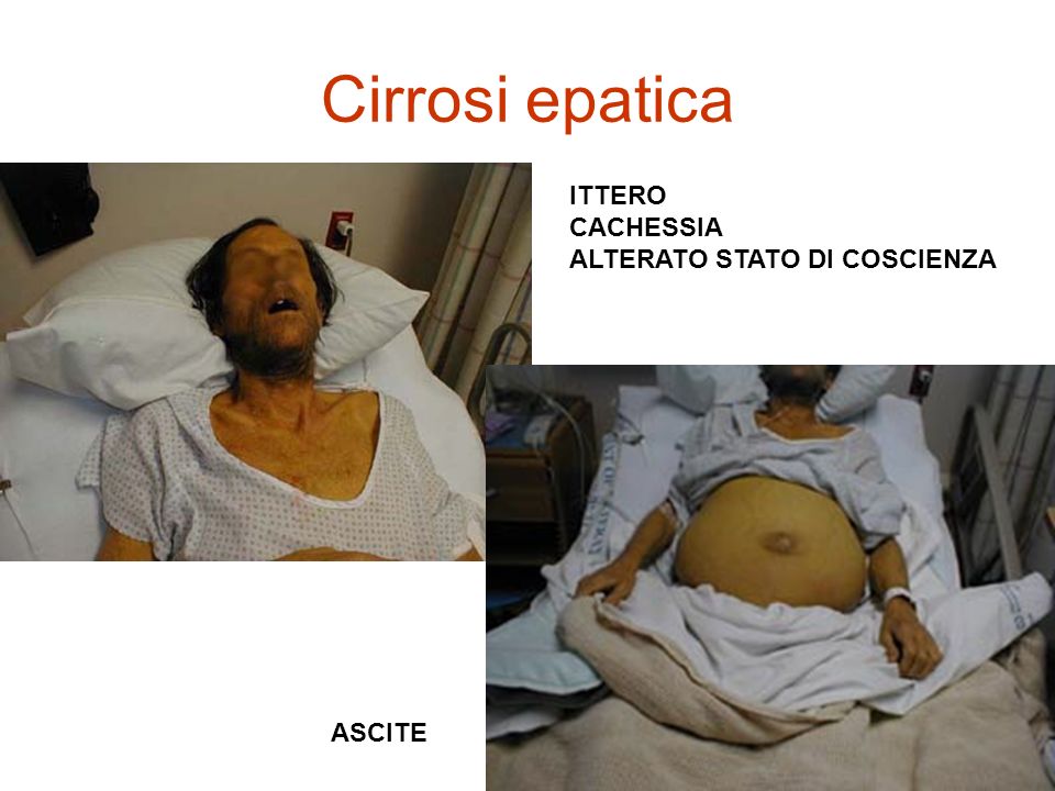 Cirrosi epatica ITTERO CACHESSIA ALTERATO STATO DI COSCIENZA ASCITE