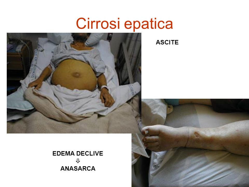 Cirrosi epatica ASCITE EDEMA DECLIVE  ANASARCA