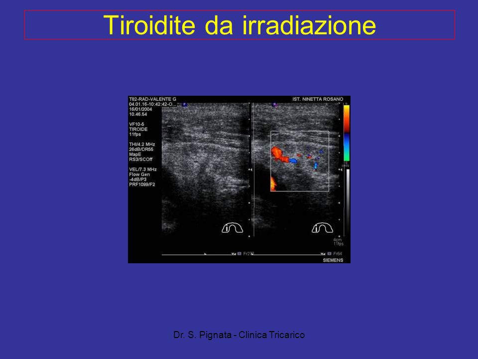 Tiroidite da irradiazione