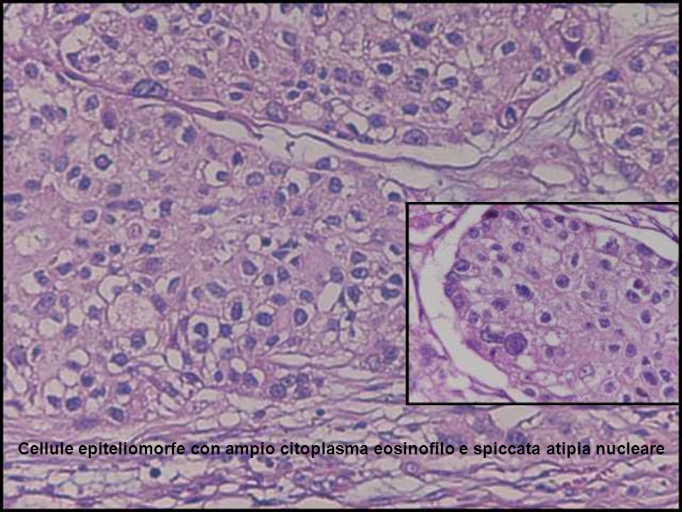 Cellule epiteliomorfe con ampio citoplasma eosinofilo e spiccata atipia nucleare