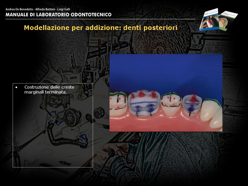 Modellazione per addizione: denti posteriori