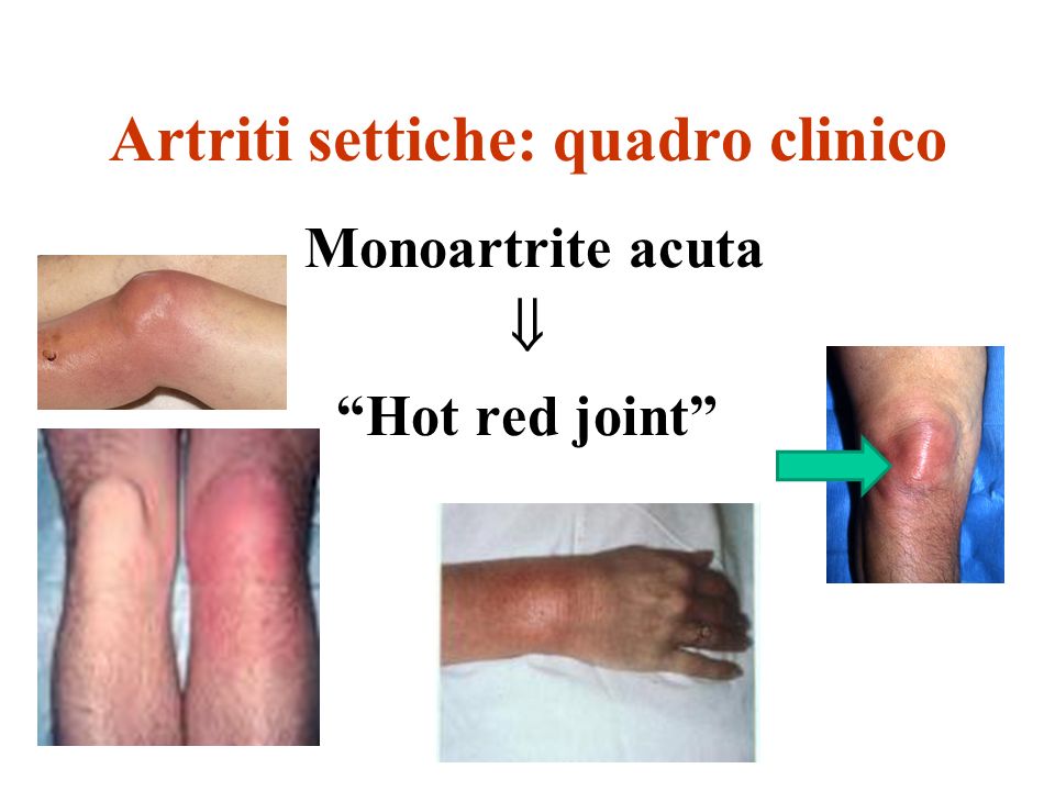 artrite settica: sintomi)