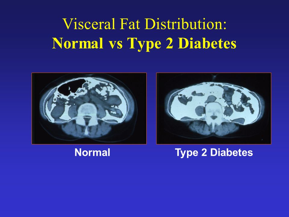 Visceral Fat Distribution: Normal vs Type 2 Diabetes