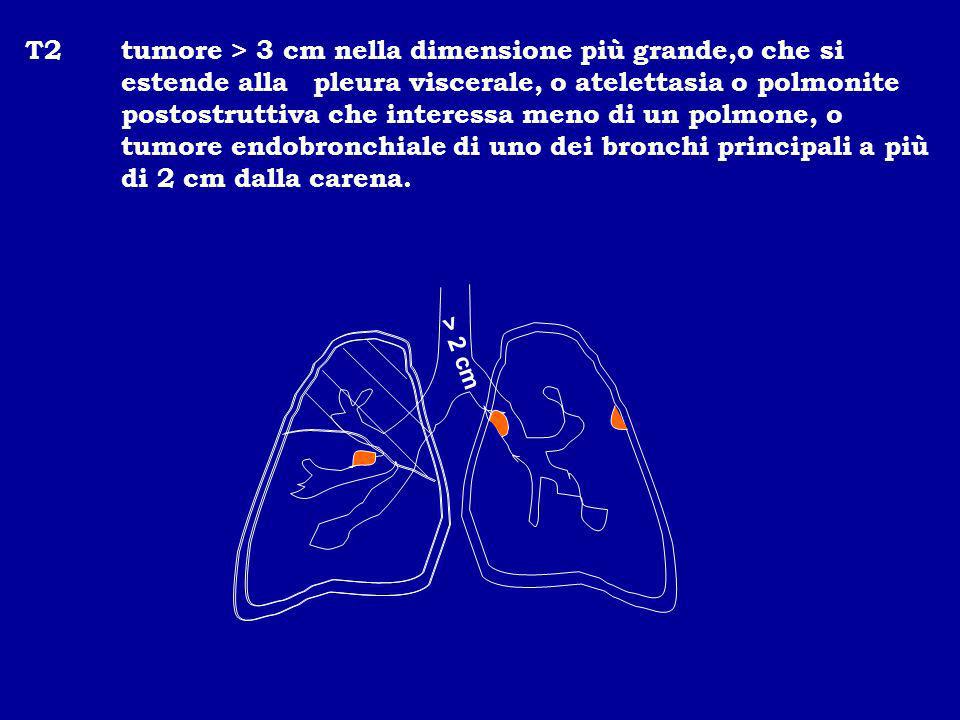 T2 tumore > 3 cm nella dimensione più grande,o che si estende alla pleura viscerale, o atelettasia o polmonite postostruttiva che interessa meno di un polmone, o tumore endobronchiale di uno dei bronchi principali a più di 2 cm dalla carena.