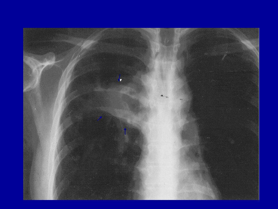 Immagine radiografica prima della CT, al tempo T0