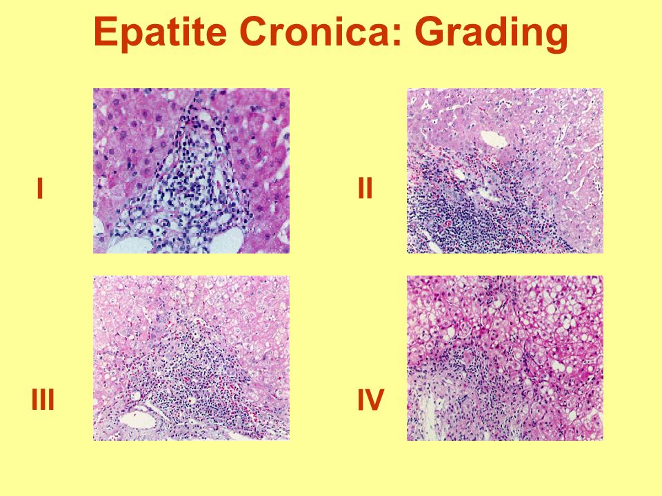 Epatite Cronica: Grading