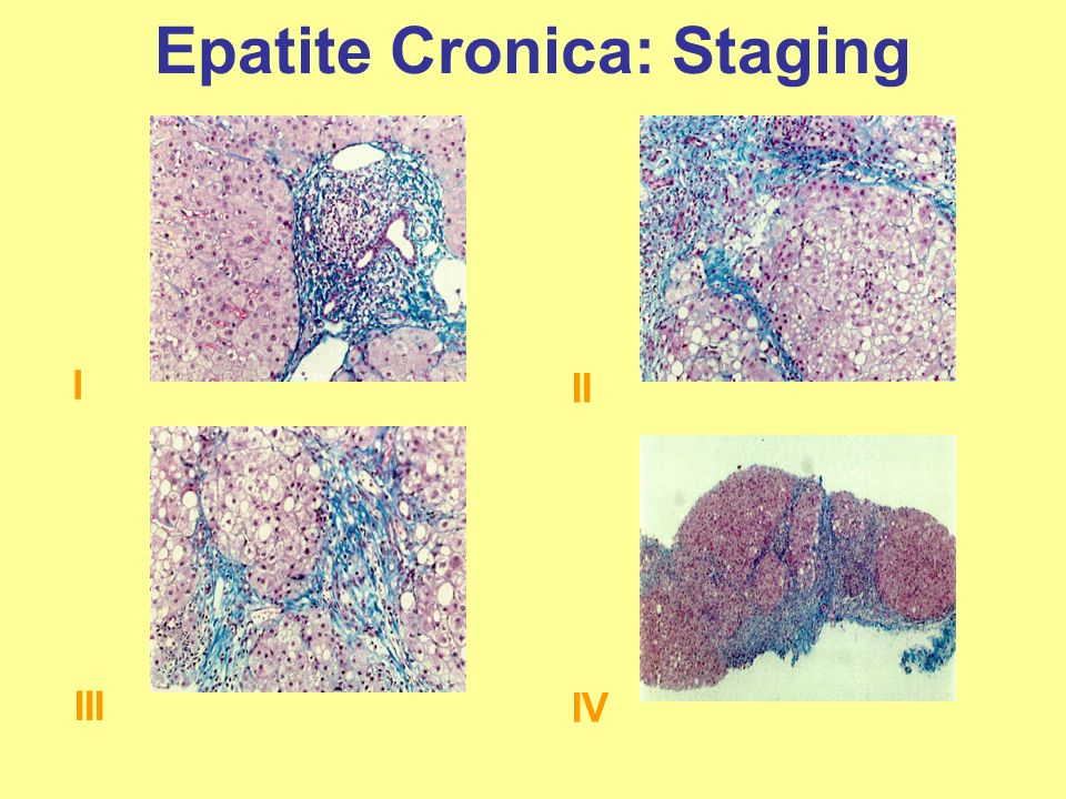 Epatite Cronica: Staging