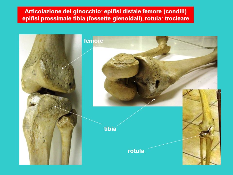 Articolazione del ginocchio: epifisi distale femore (condili) epifisi prossimale tibia (fossette glenoidali), rotula: trocleare