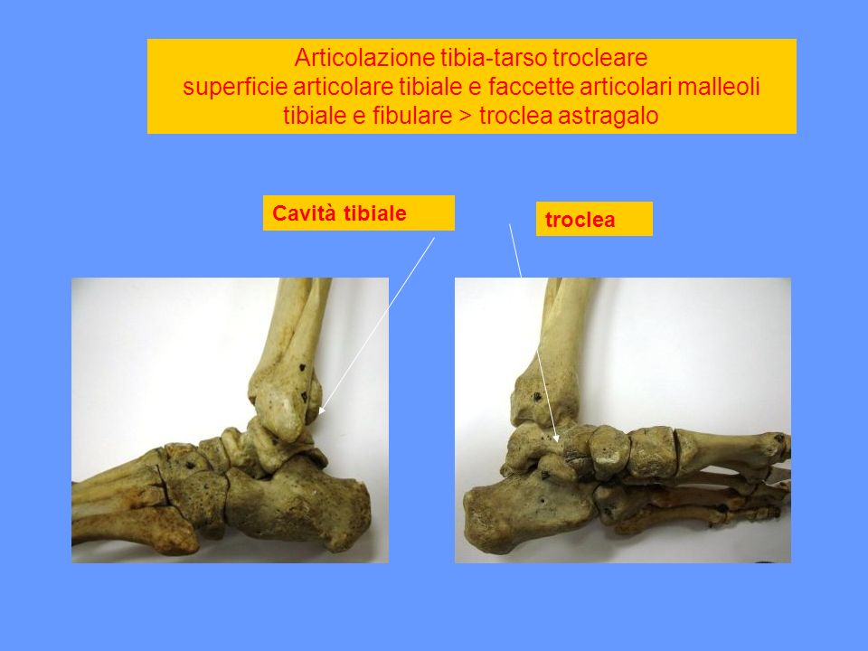 Articolazione tibia-tarso trocleare superficie articolare tibiale e faccette articolari malleoli tibiale e fibulare > troclea astragalo