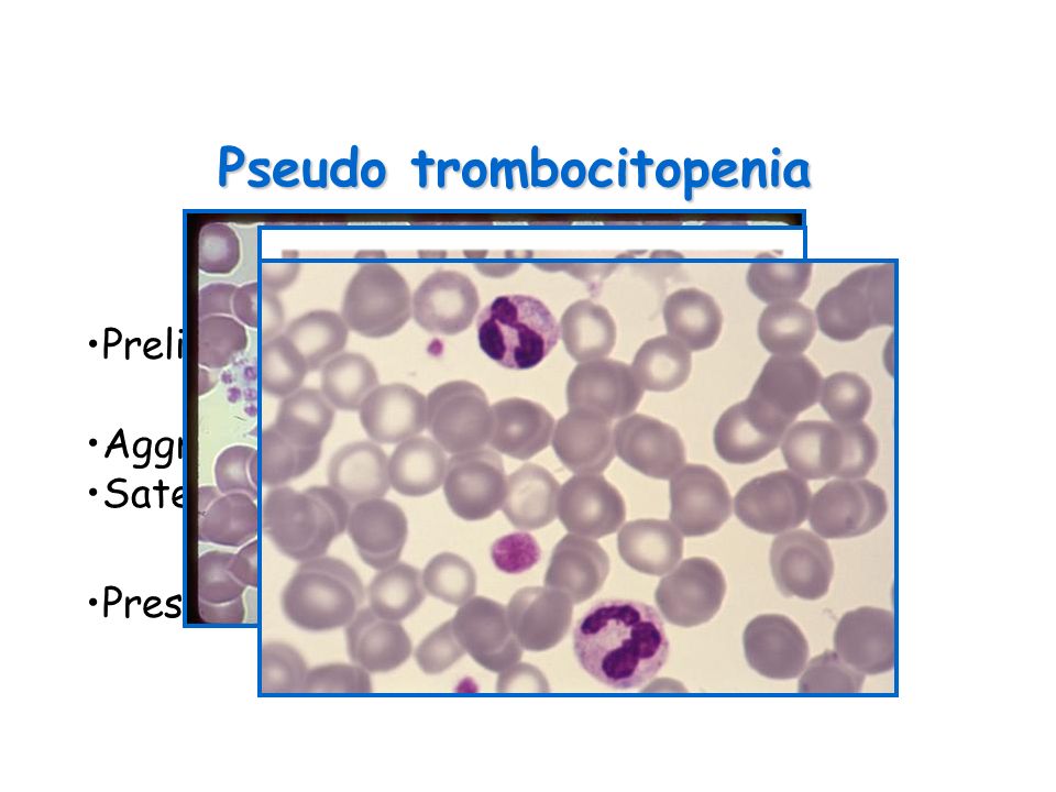Pseudo trombocitopenia