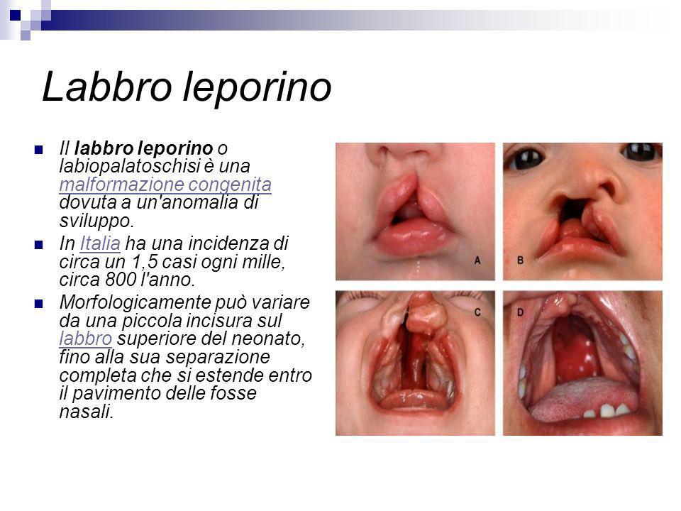 Labbro leporino Il labbro leporino o labiopalatoschisi è una malformazione congenita dovuta a un anomalia di sviluppo.