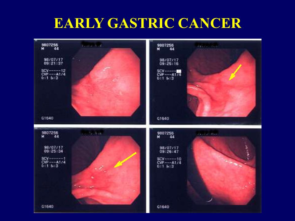 EARLY GASTRIC CANCER