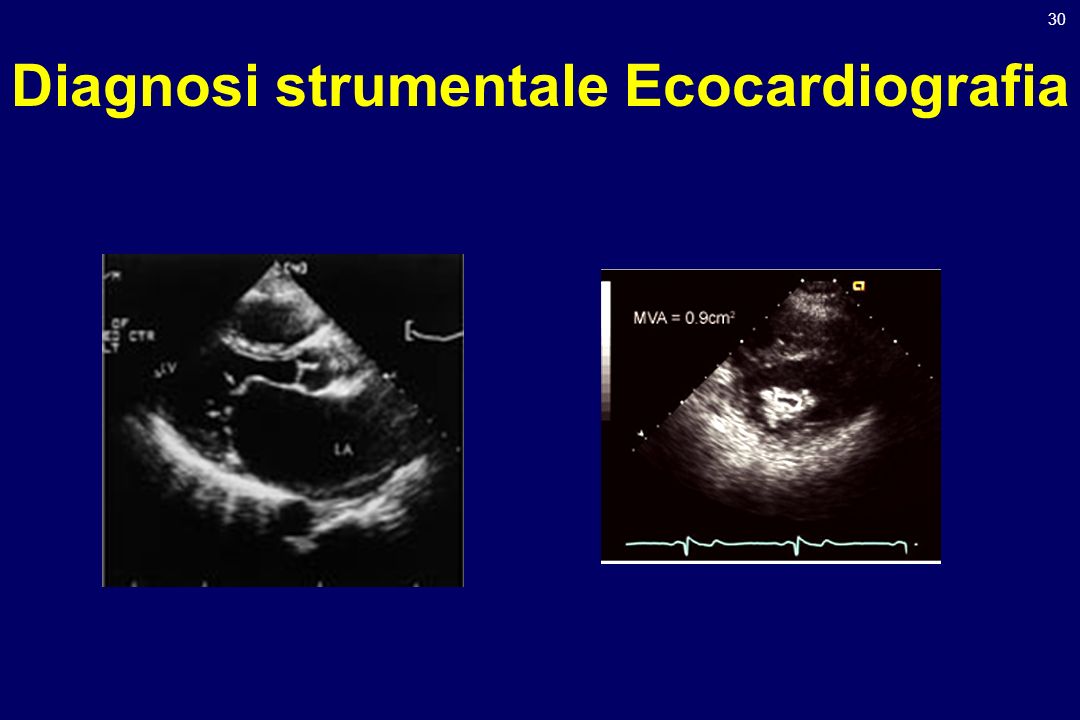 Diagnosi strumentale Ecocardiografia
