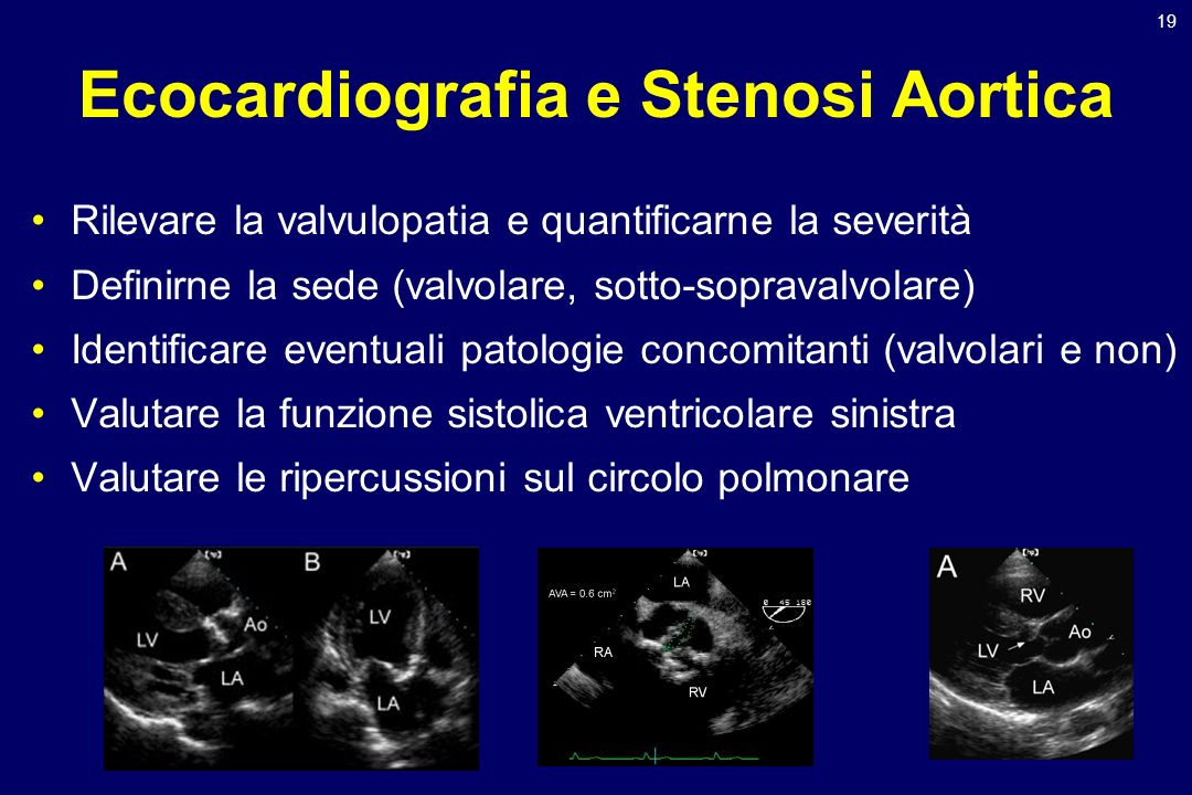 Ecocardiografia e Stenosi Aortica