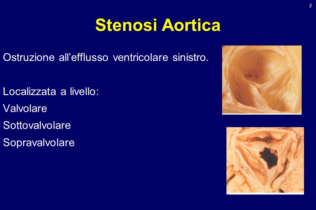 Stenosi Aortica Ostruzione all’efflusso ventricolare sinistro.