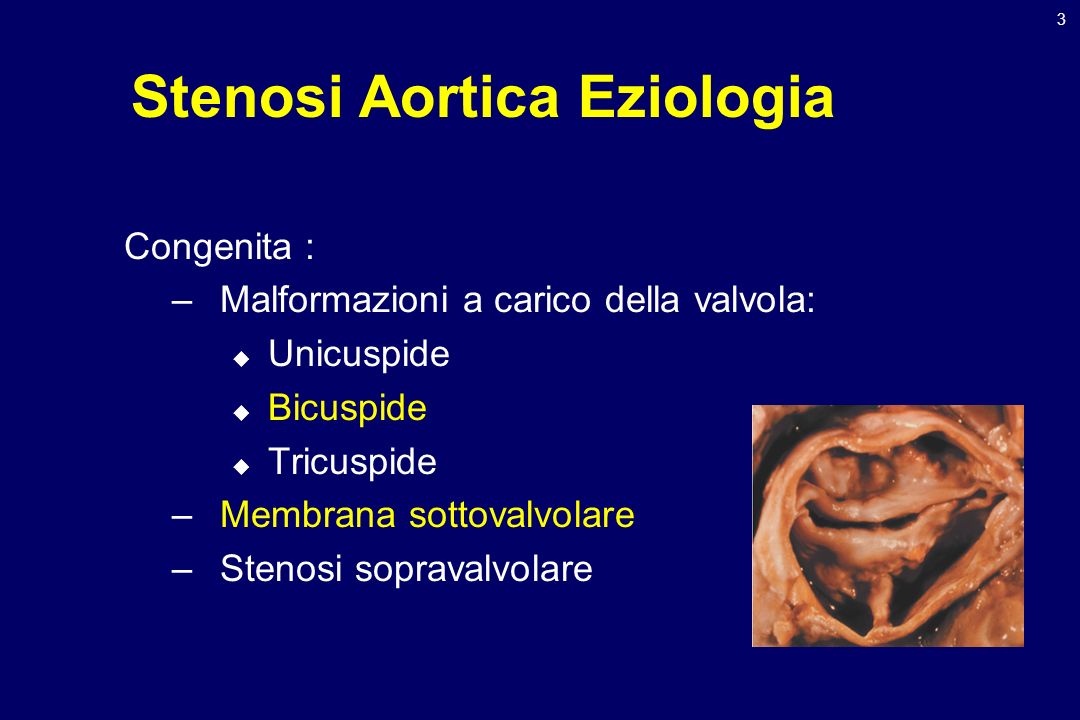 Stenosi Aortica Eziologia