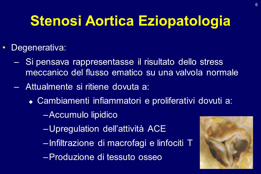 Stenosi Aortica Eziopatologia