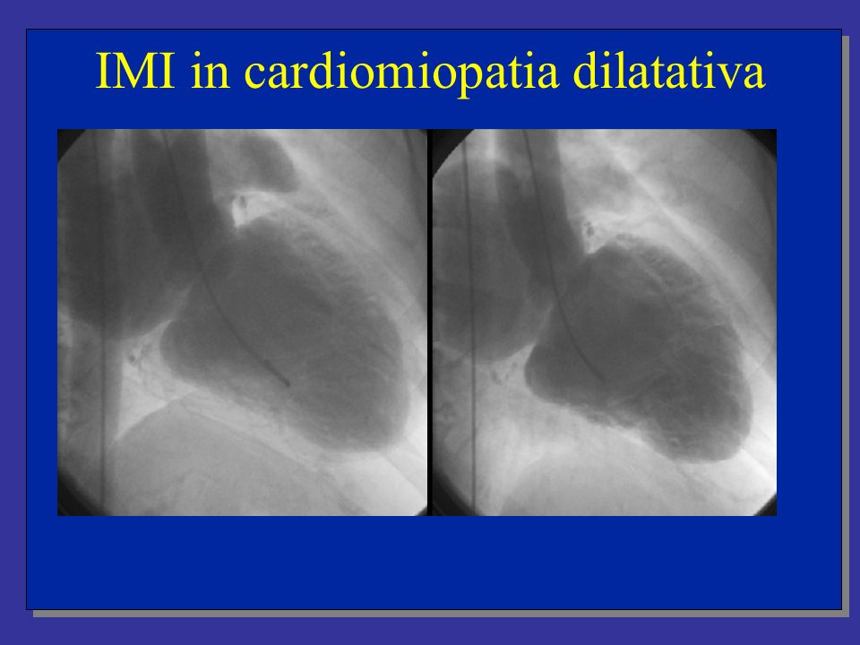 IMI in cardiomiopatia dilatativa