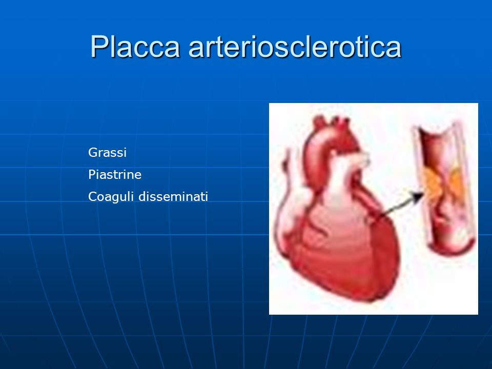 Placca arteriosclerotica