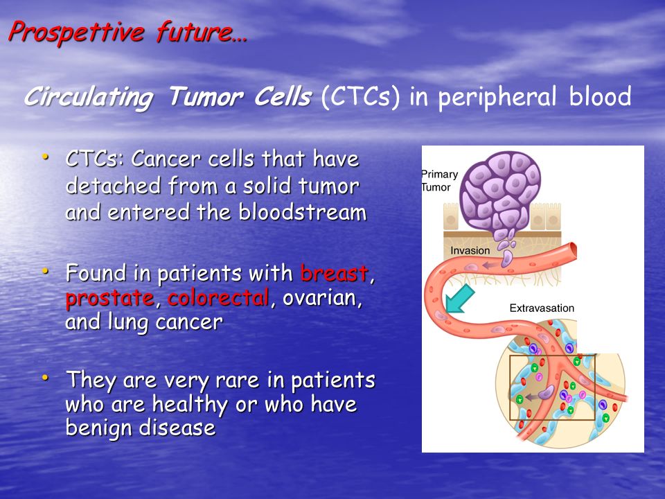 Circulating Tumor Cells (CTCs) in peripheral blood
