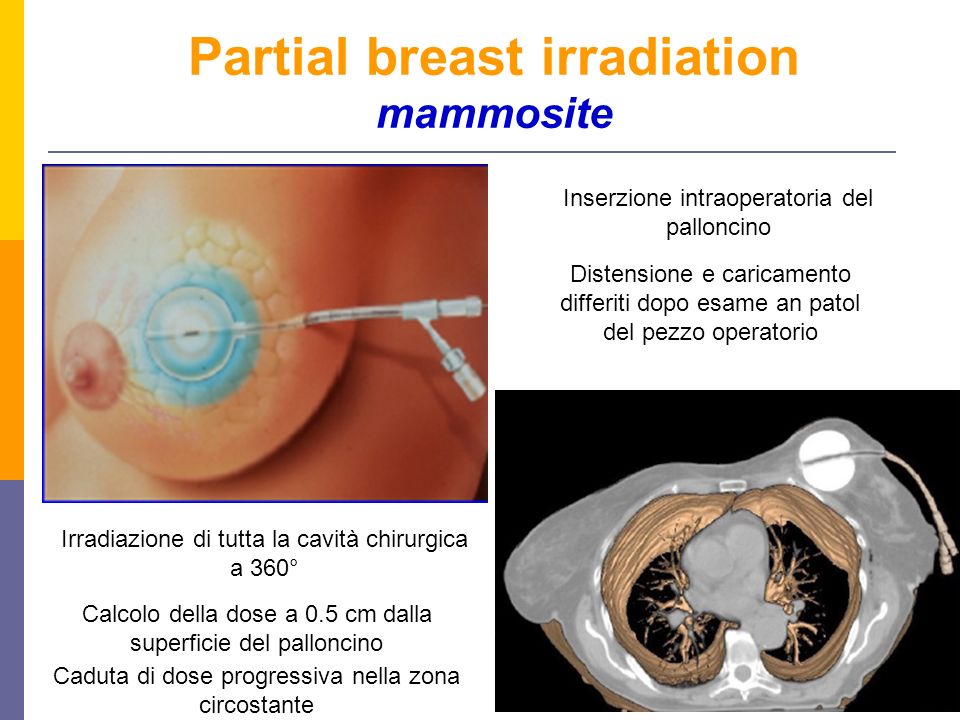 Partial breast irradiation mammosite