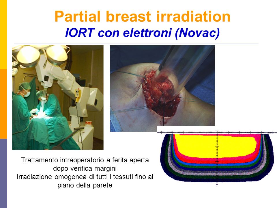 Partial breast irradiation IORT con elettroni (Novac)