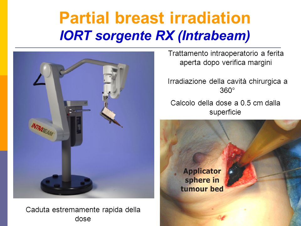 Partial breast irradiation IORT sorgente RX (Intrabeam)