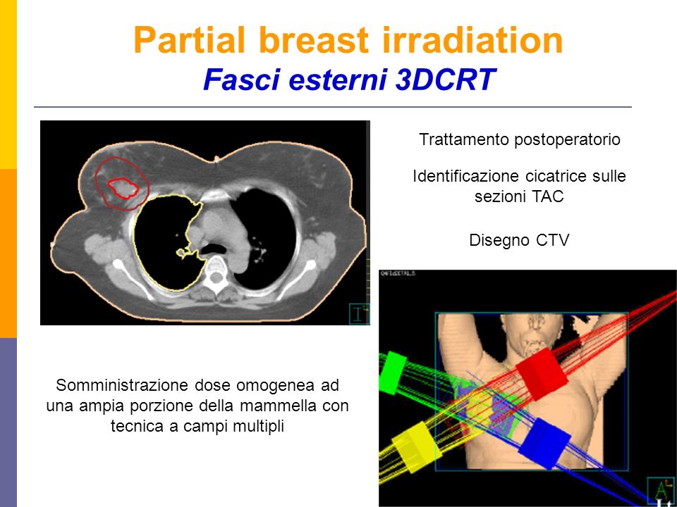 Partial breast irradiation Fasci esterni 3DCRT