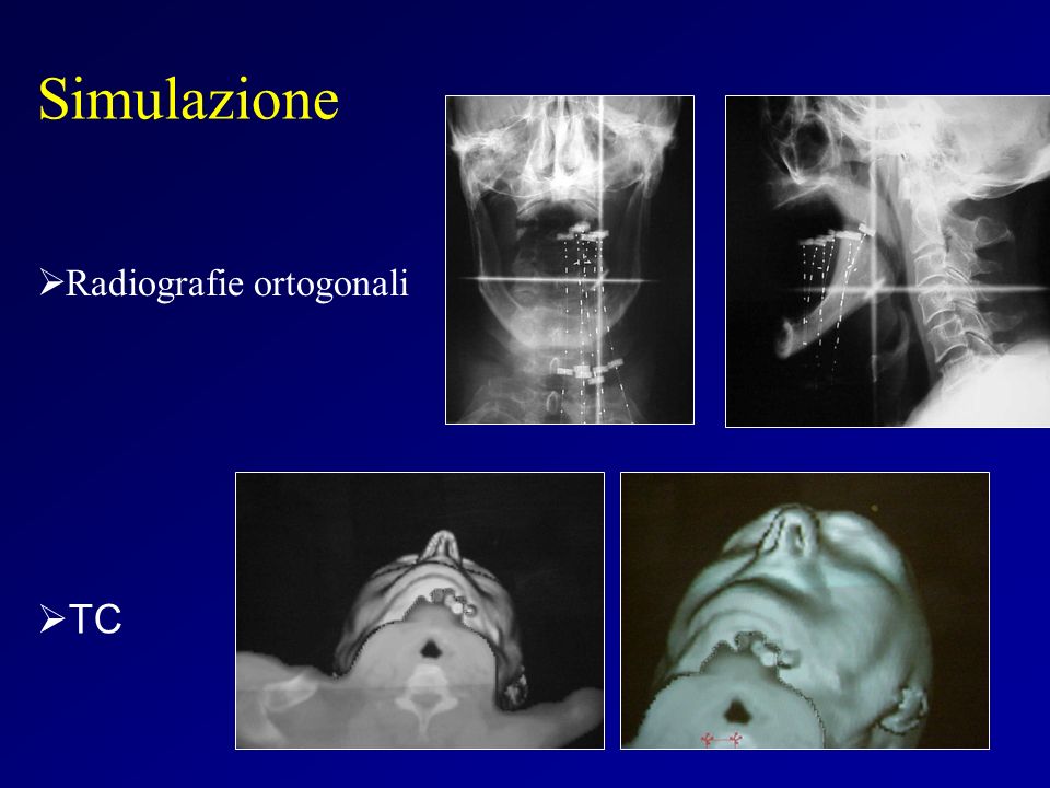 Simulazione Radiografie ortogonali TC