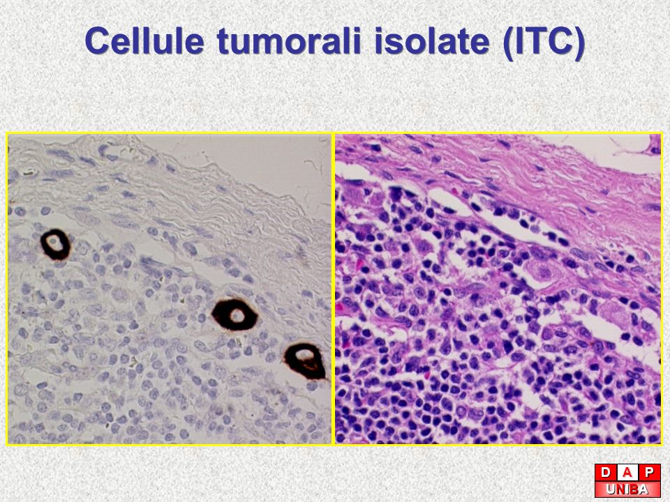 Cellule tumorali isolate (ITC)