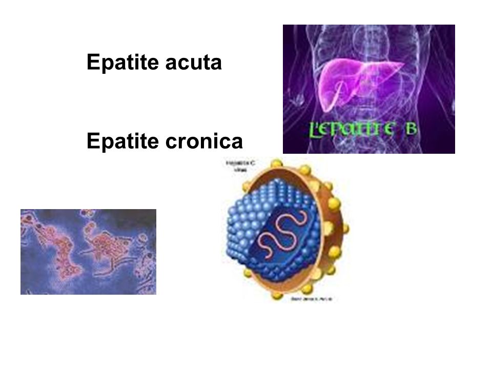 Epatite acuta Epatite cronica