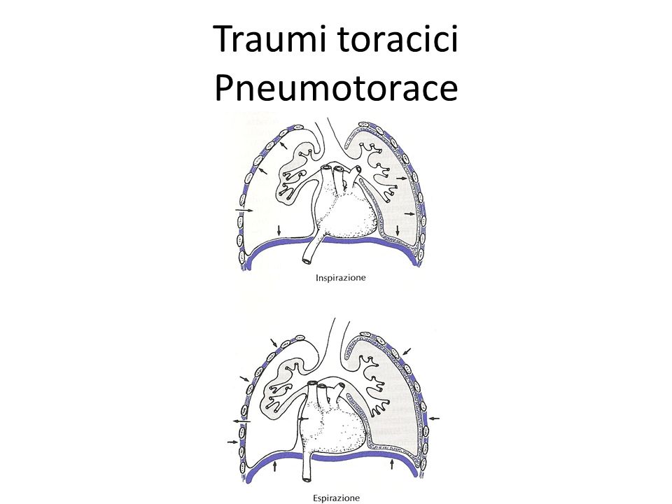 Traumi toracici Pneumotorace