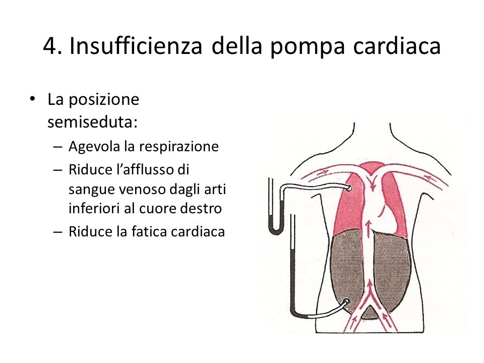 4. Insufficienza della pompa cardiaca