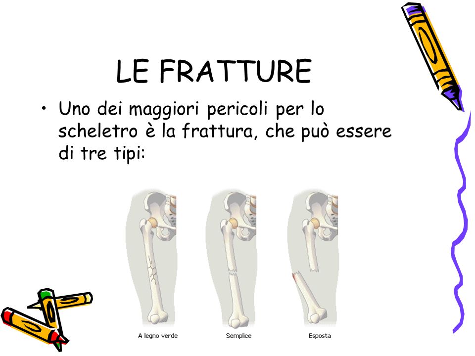 LE FRATTURE Uno dei maggiori pericoli per lo scheletro è la frattura, che può essere di tre tipi: