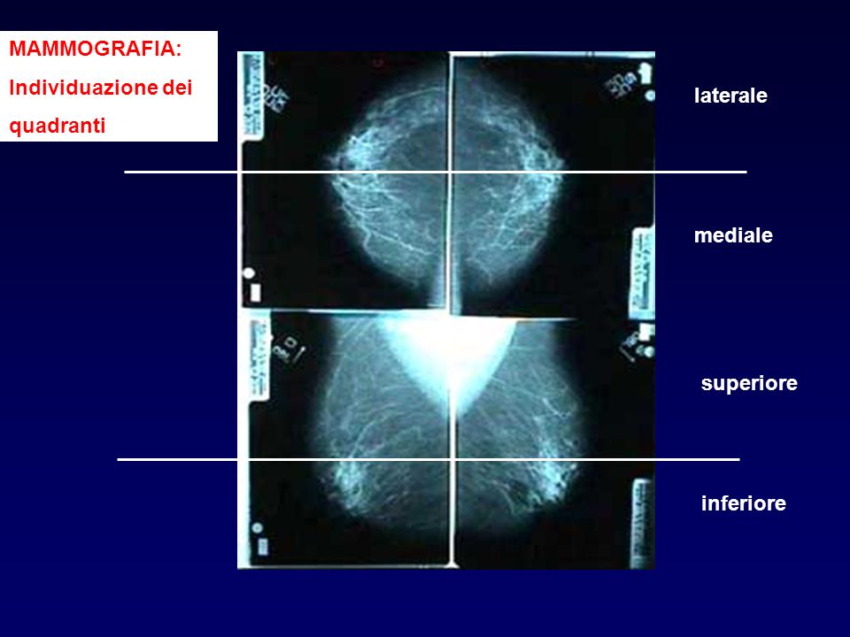 MAMMOGRAFIA: Individuazione dei quadranti laterale mediale superiore inferiore