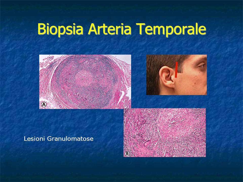 Biopsia Arteria Temporale