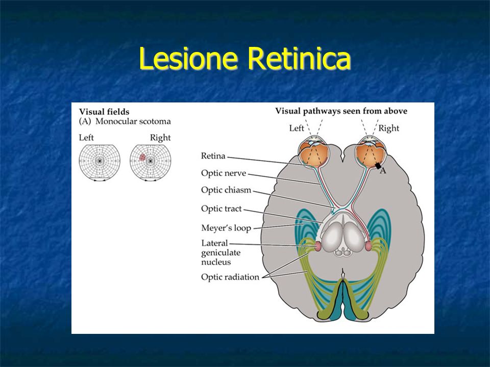Lesione Retinica