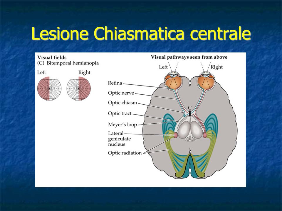 Lesione Chiasmatica centrale