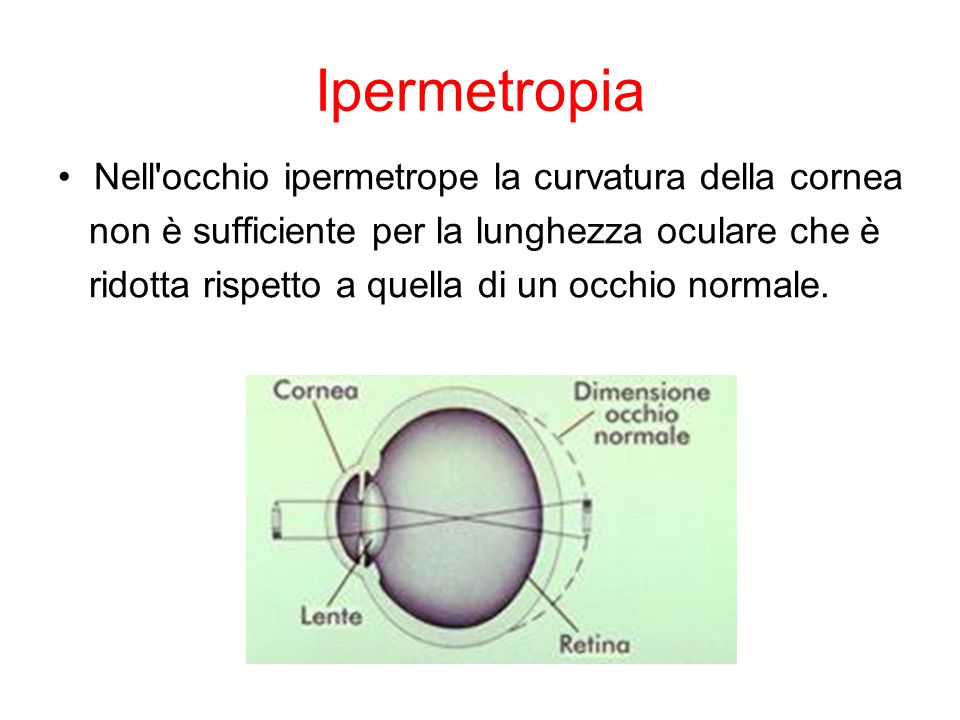 Ipermetropia Nell occhio ipermetrope la curvatura della cornea