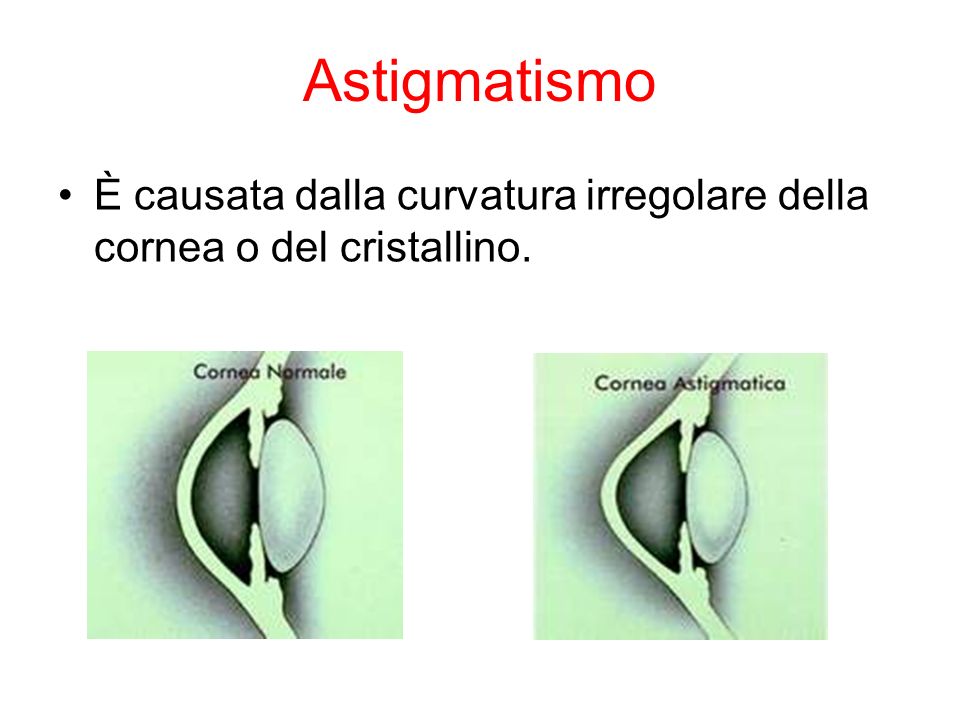 Astigmatismo È causata dalla curvatura irregolare della cornea o del cristallino.
