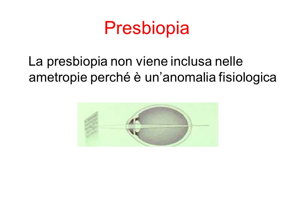Presbiopia La presbiopia non viene inclusa nelle ametropie perché è un’anomalia fisiologica