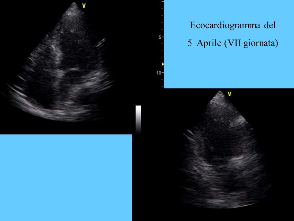 Ecocardiogramma del 5 Aprile (VII giornata)