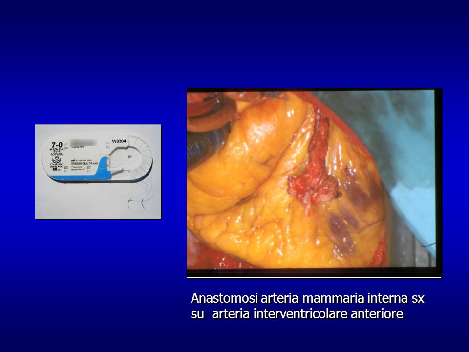 Anastomosi arteria mammaria interna sx su arteria interventricolare anteriore