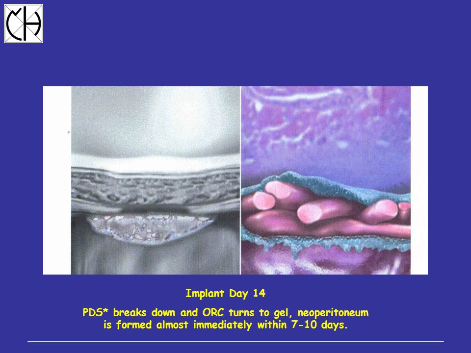 Implant Day 14 PDS* breaks down and ORC turns to gel, neoperitoneum is formed almost immediately within 7-10 days.