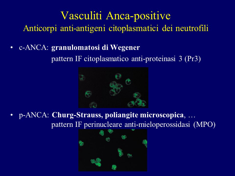 Vasculiti Anca-positive Anticorpi anti-antigeni citoplasmatici dei neutrofili