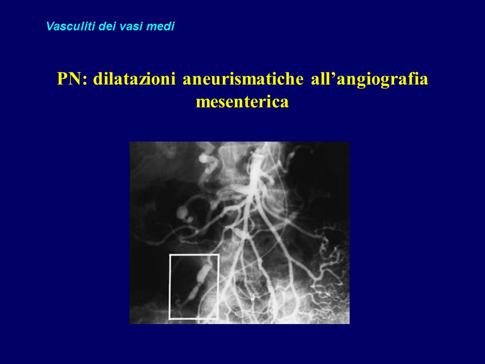 PN: dilatazioni aneurismatiche all’angiografia mesenterica
