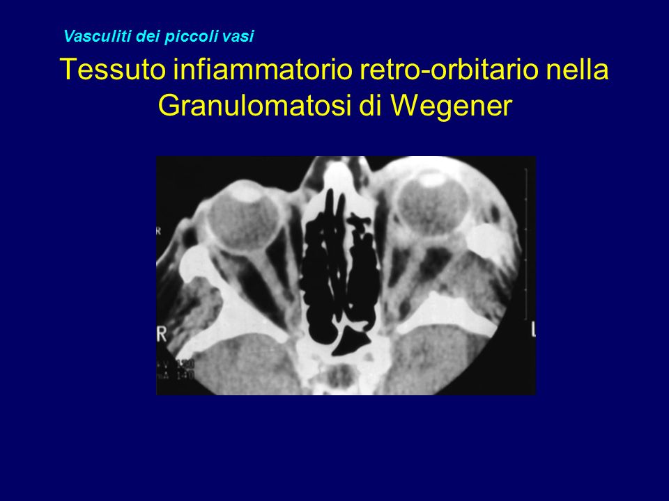 Tessuto infiammatorio retro-orbitario nella Granulomatosi di Wegener